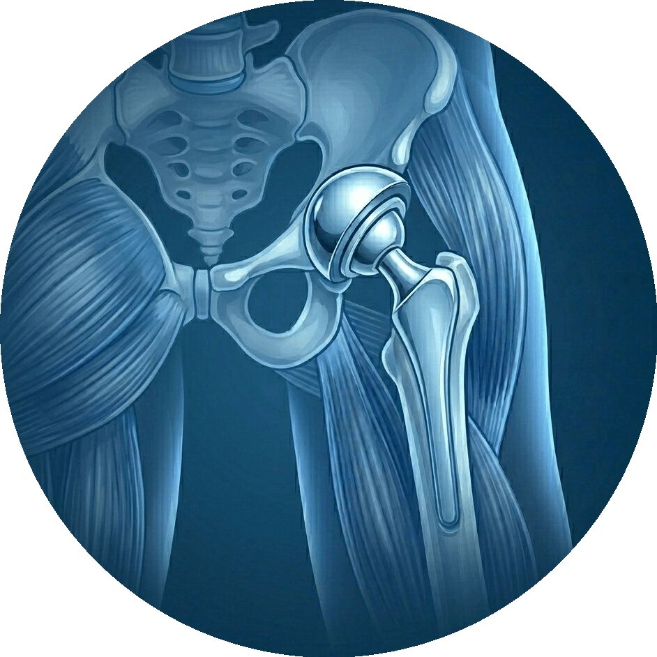 Hip Replacement