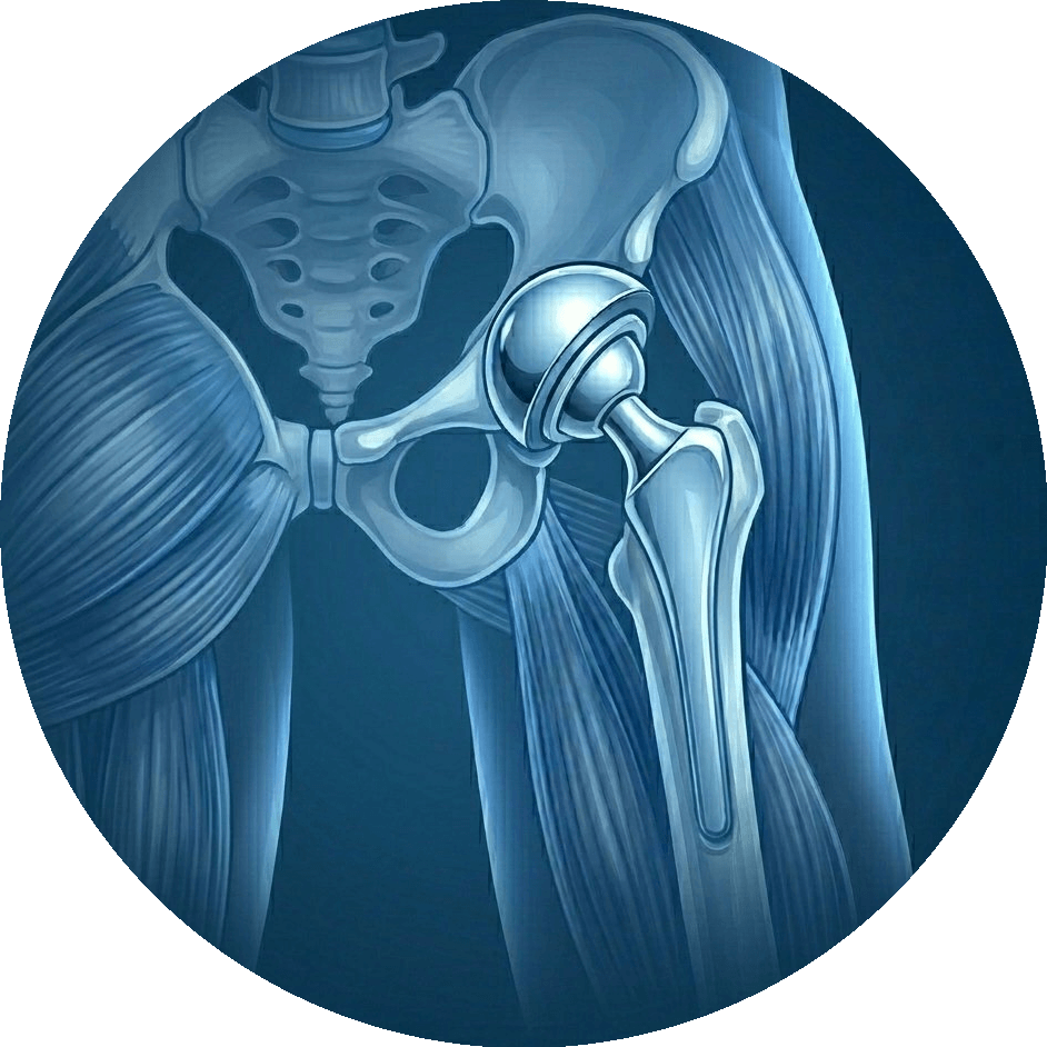 Hip Replacement